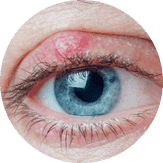 Palpebra infiammata per un orzaiolo